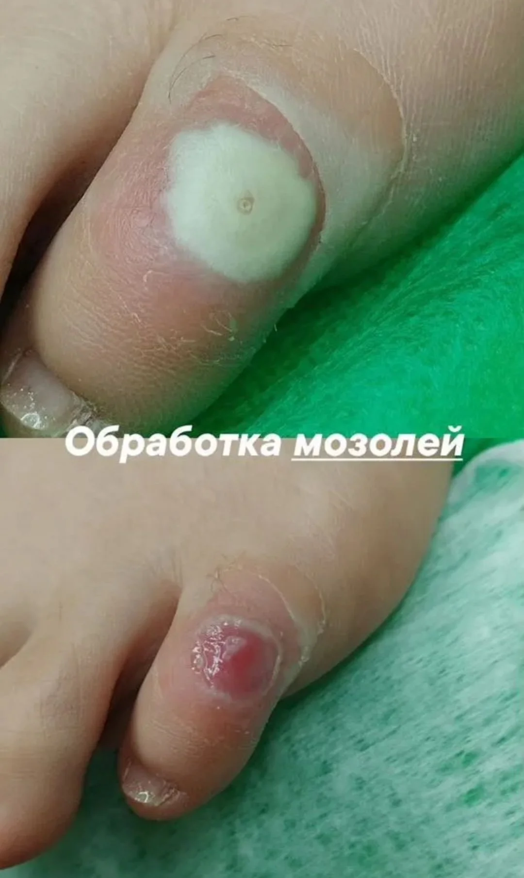 Подолог в кабинете и на дом - миниатюра 7