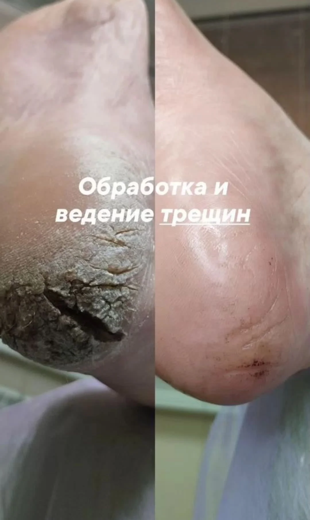 Подолог в кабинете и на дом - миниатюра 9