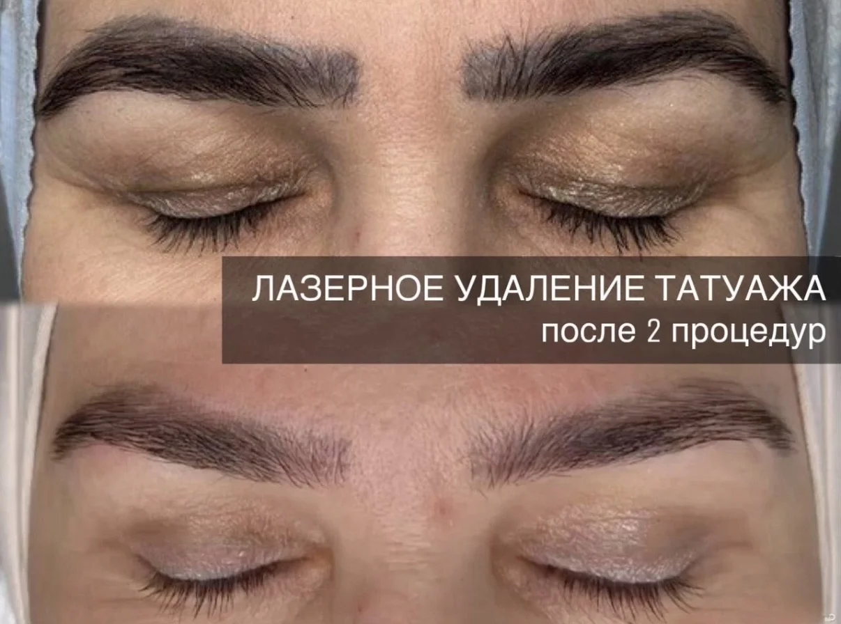 Удаление татуажа, перманентного макияжа - миниатюра 2