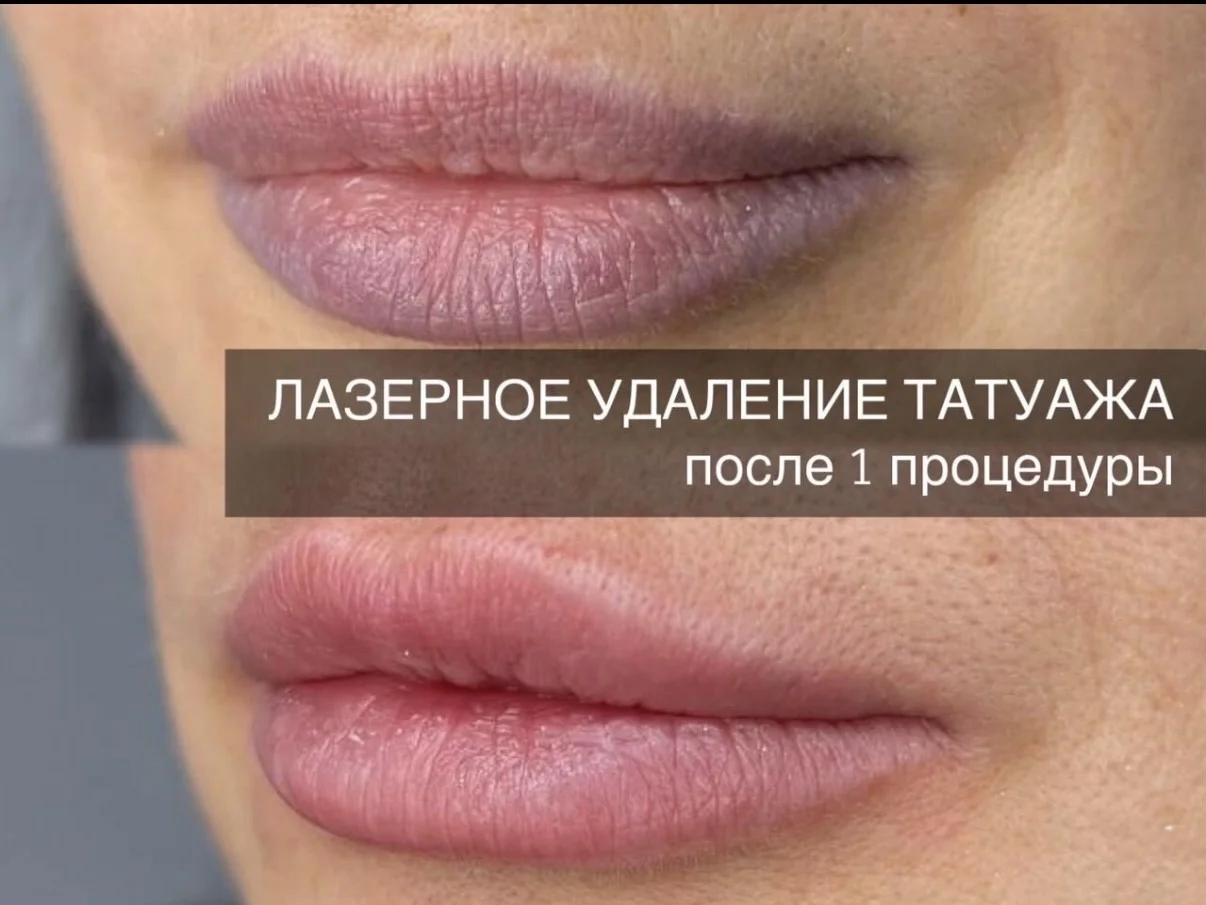 Удаление татуажа, перманентного макияжа - миниатюра 3