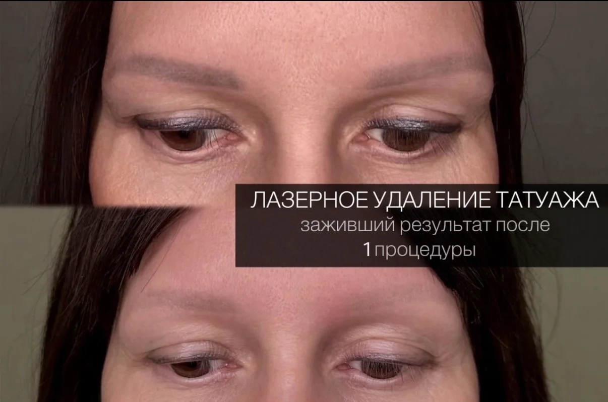 Удаление татуажа, перманентного макияжа - миниатюра 4
