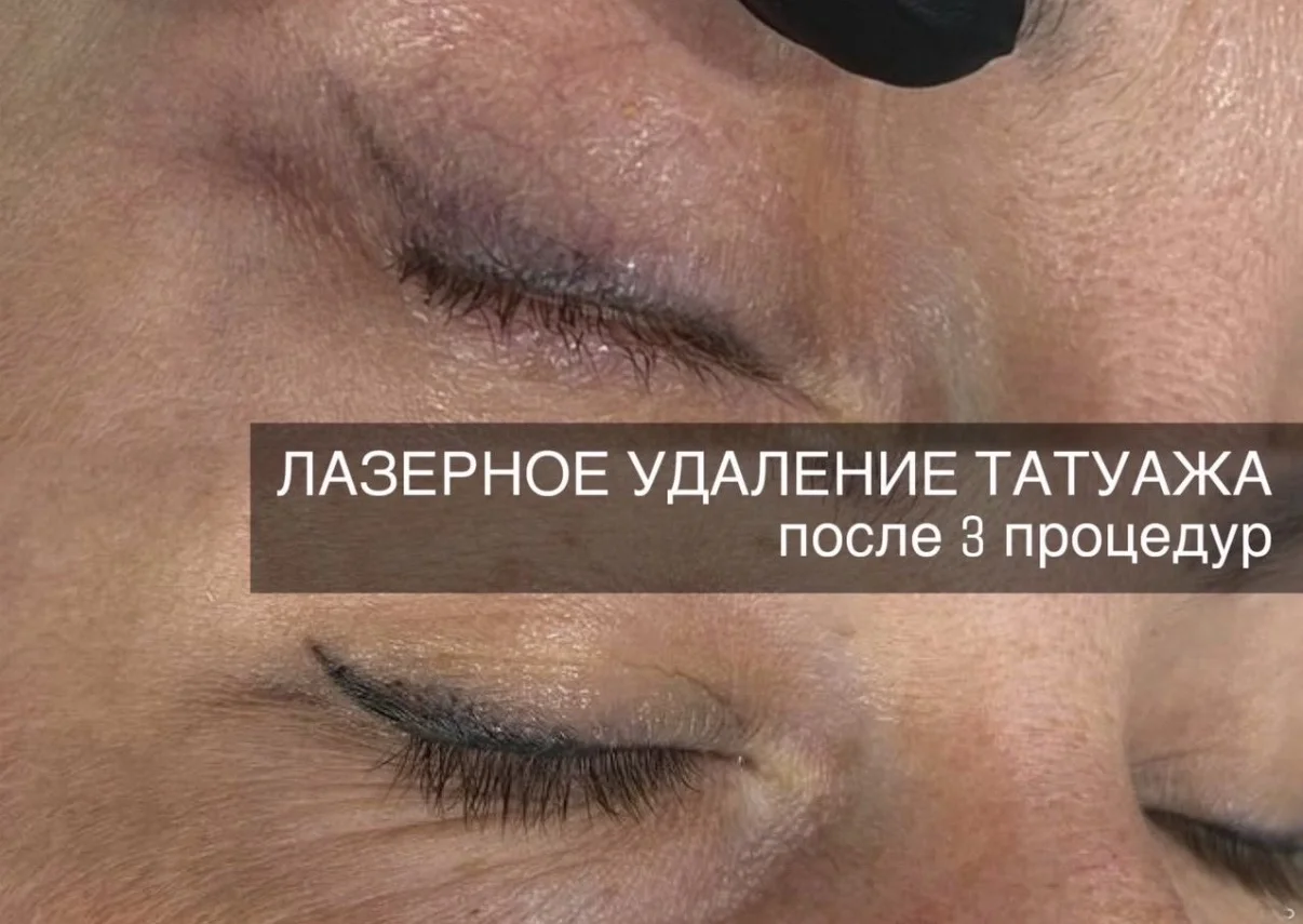 Удаление татуажа, перманентного макияжа - миниатюра 5
