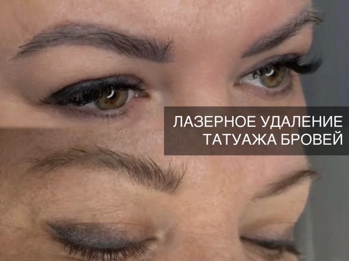 Удаление татуажа, перманентного макияжа - миниатюра 6