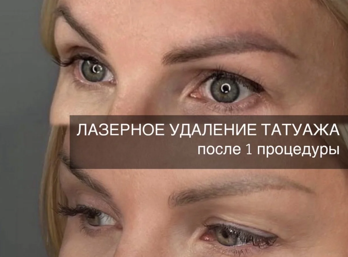 Удаление татуажа, перманентного макияжа - миниатюра 7
