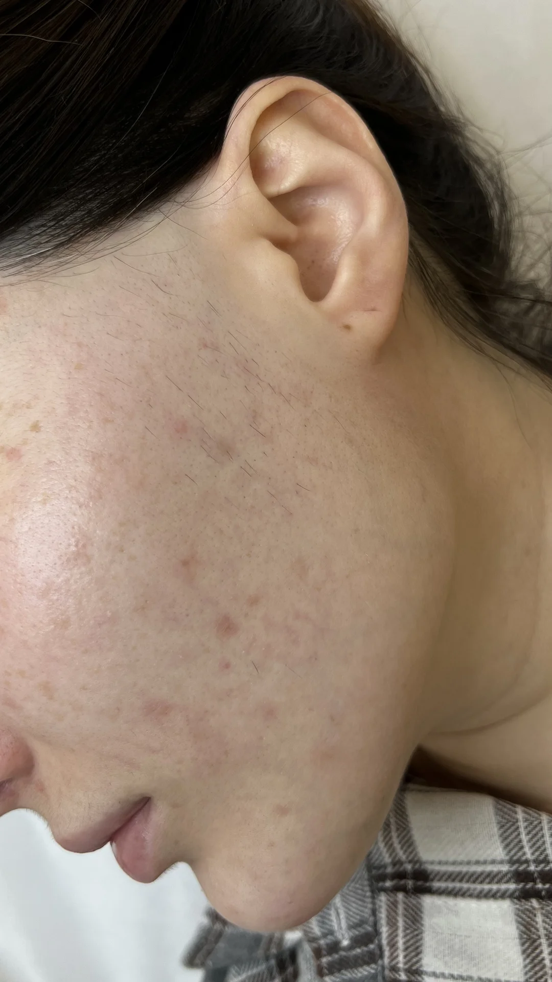 Электроэпиляция - миниатюра 2