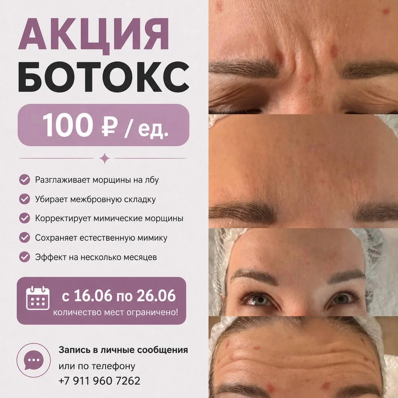 Ботокс акция - изображение 1