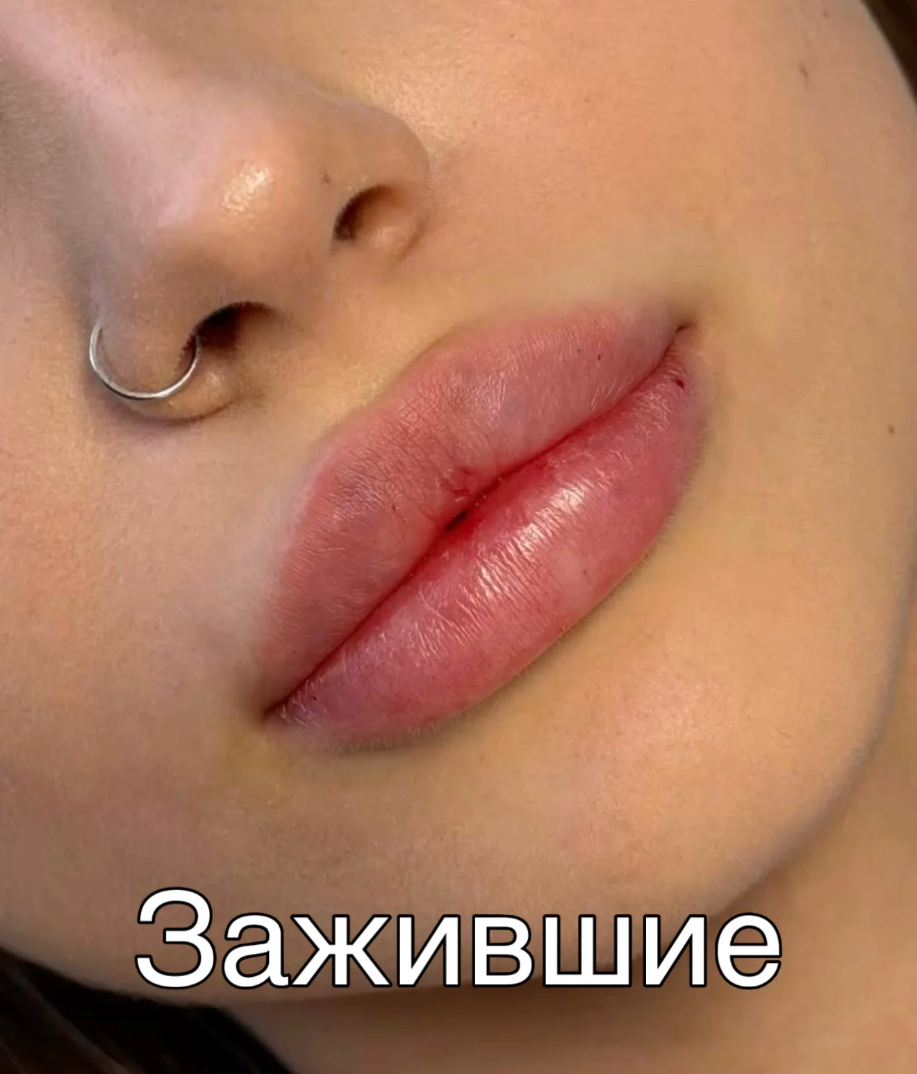 косметлогия контурная пластика губ - миниатюра 11