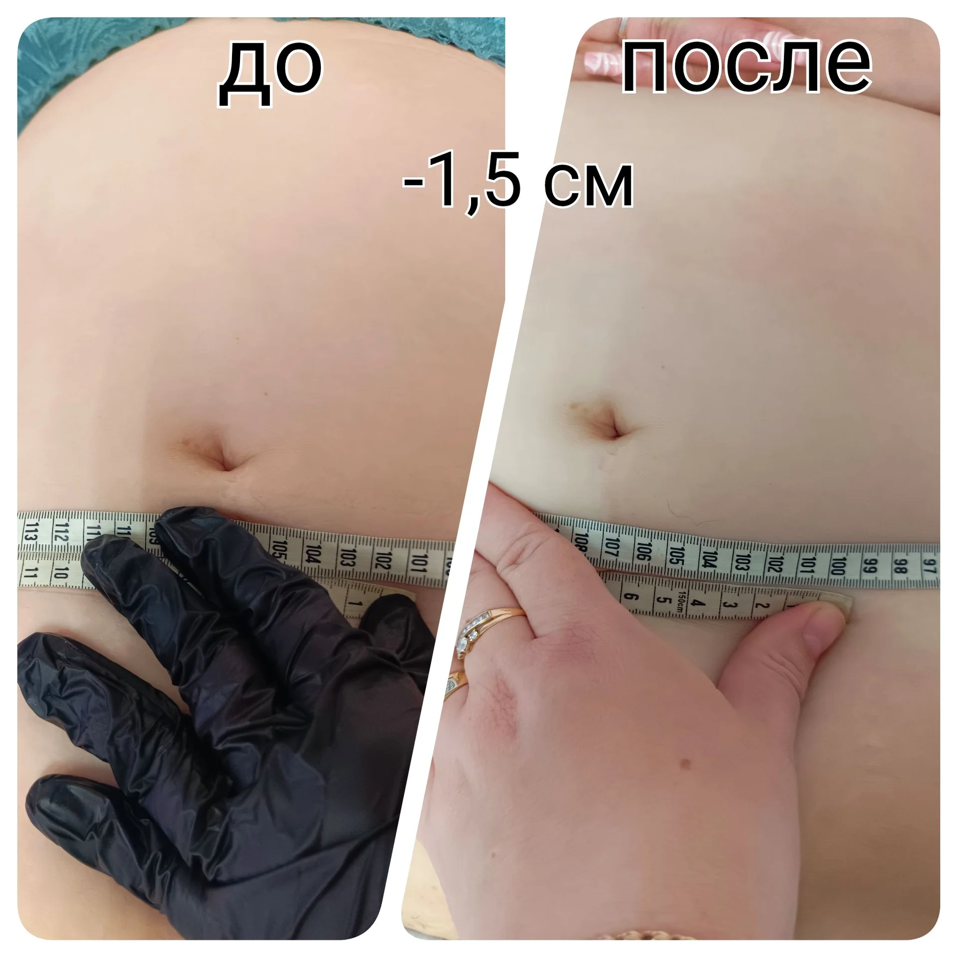 LPG, RF-лифтинг, Прессотерапия - Аппаратный массаж - миниатюра 16