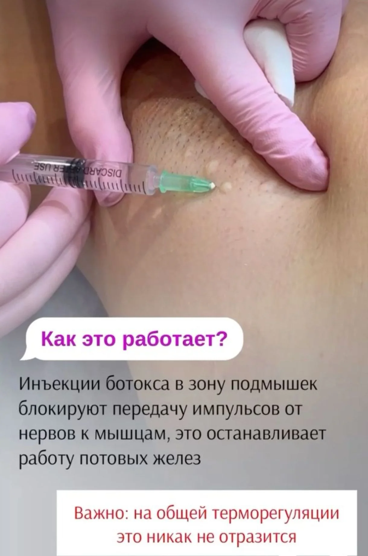 Лечение гипергидроза - миниатюра 5