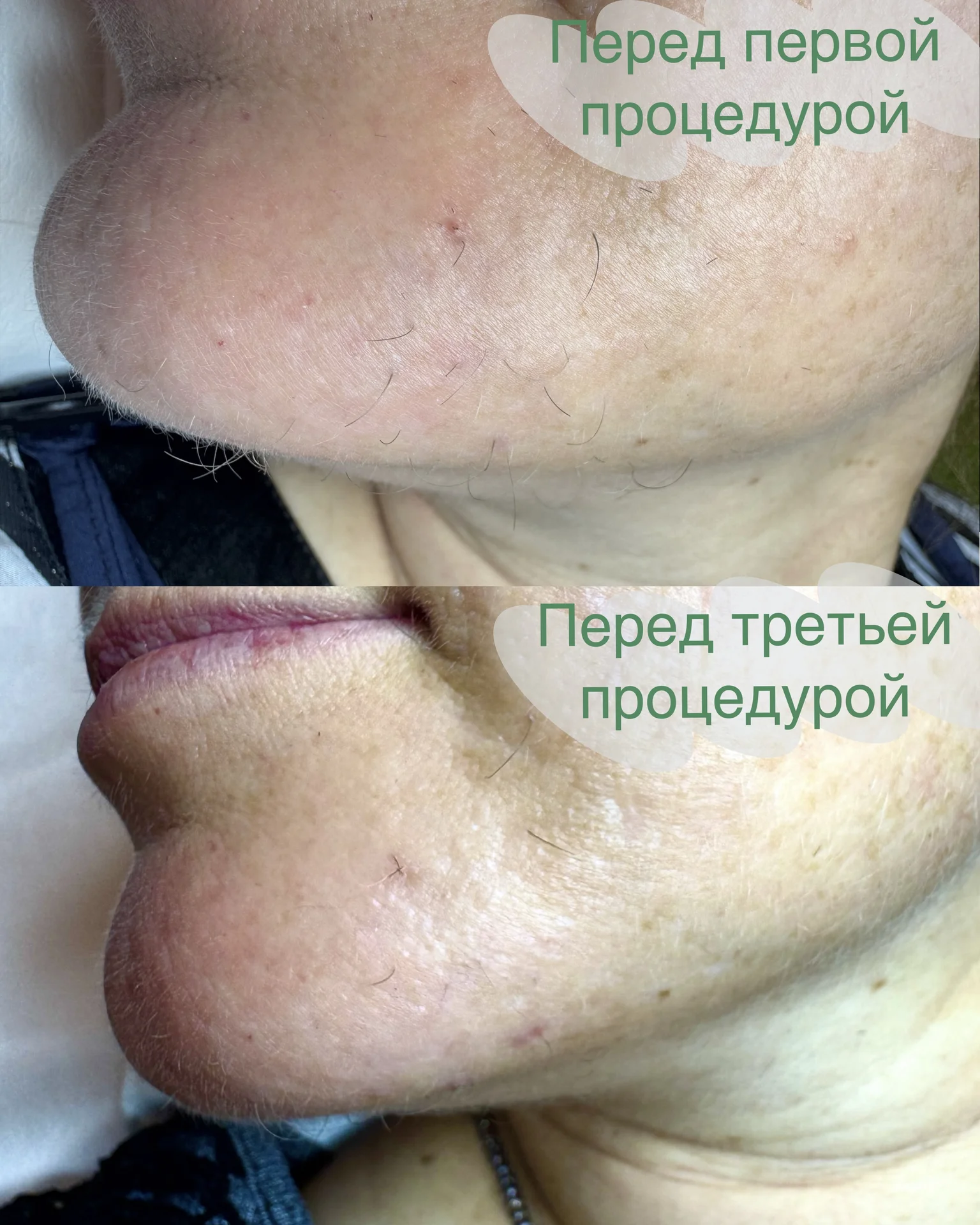 электроэпиляция - миниатюра 3