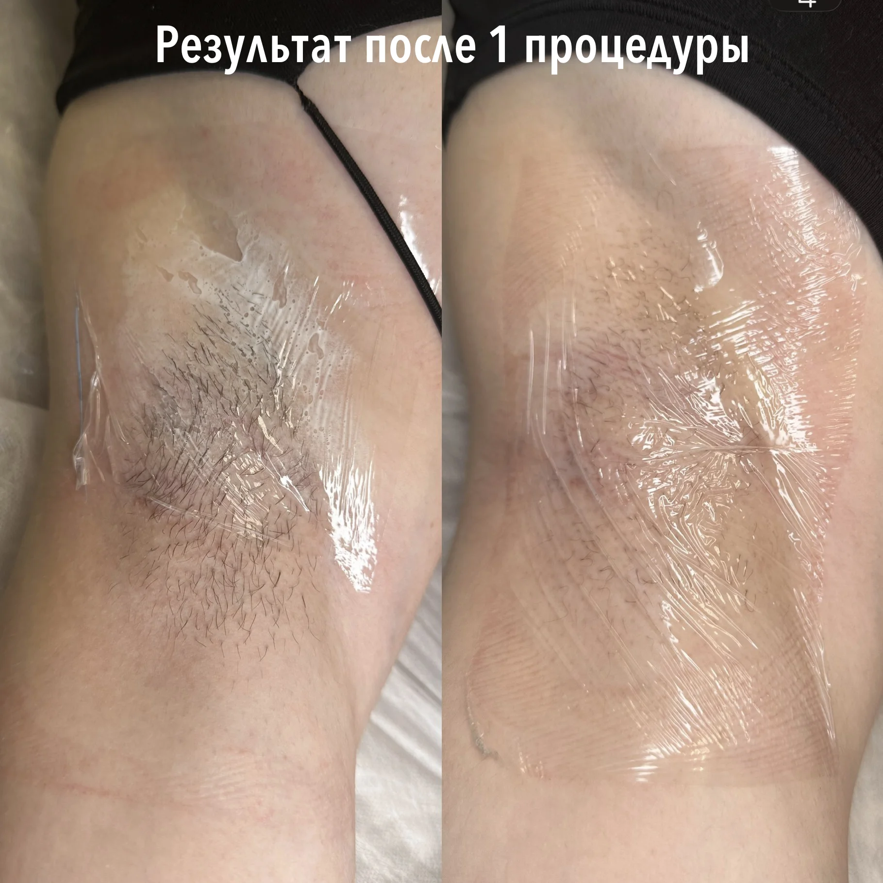 Электроэпиляция - миниатюра 3