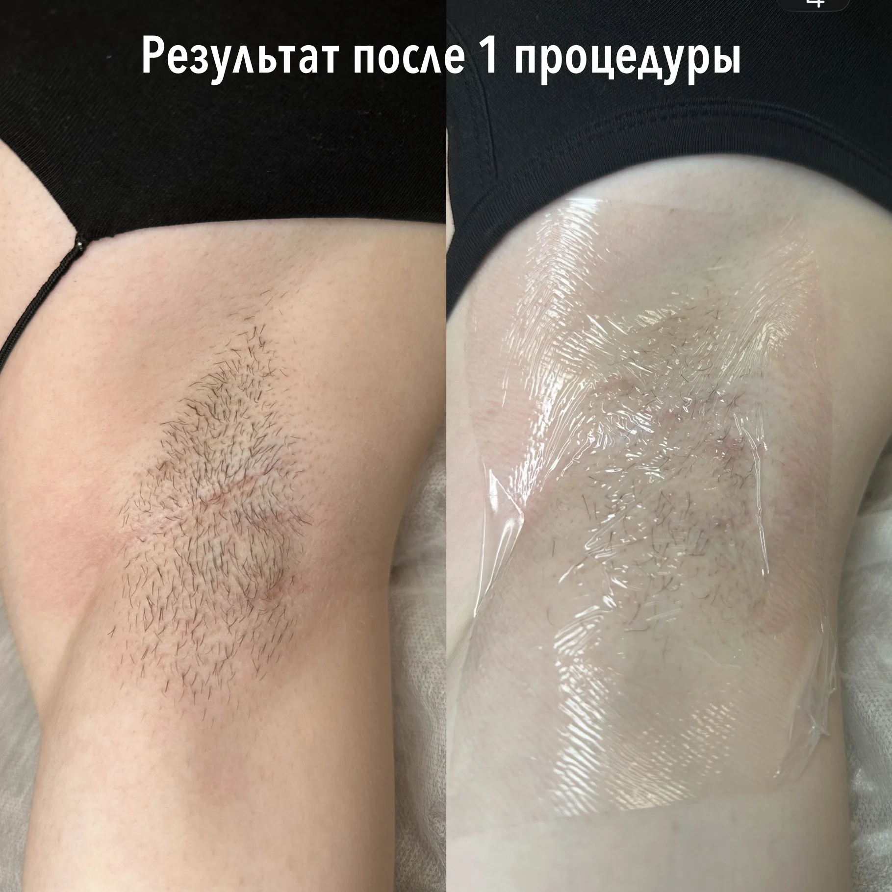 Электроэпиляция - миниатюра 4