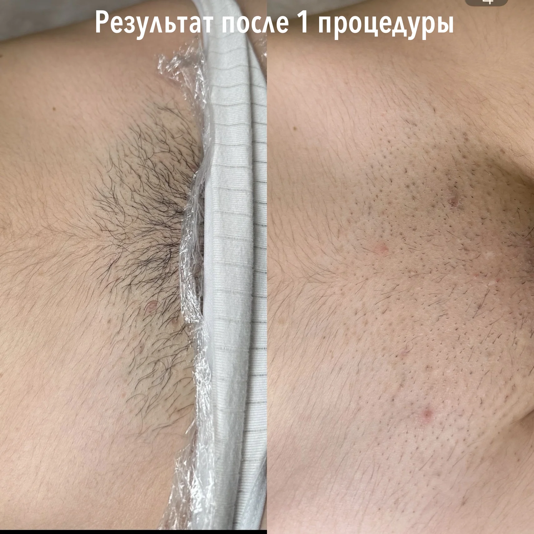 Электроэпиляция - миниатюра 5