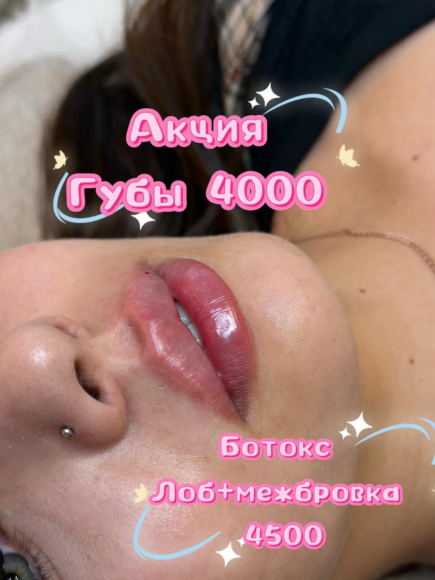 Увеличение губ - миниатюра 2