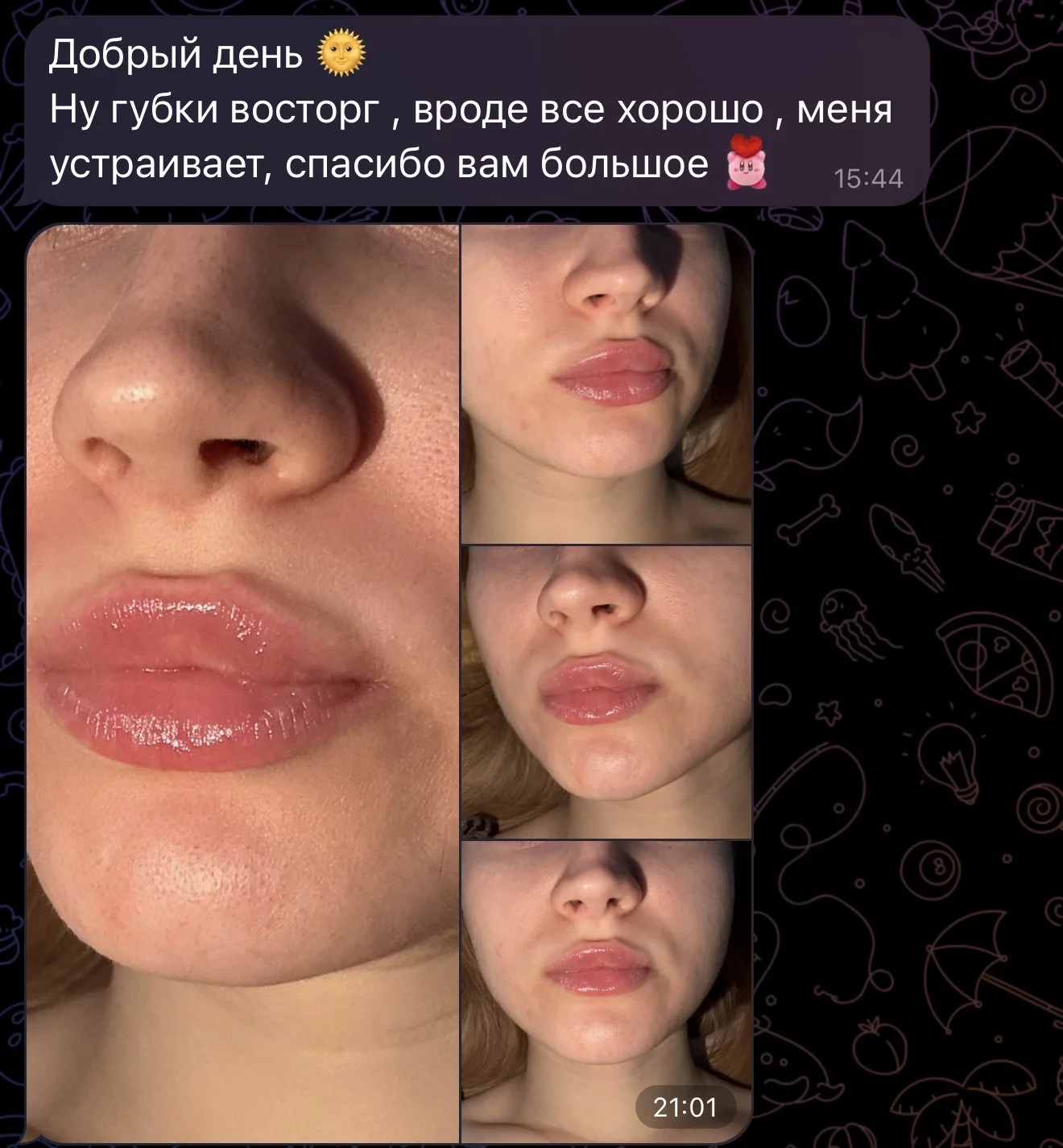 Увеличение губ - миниатюра 11
