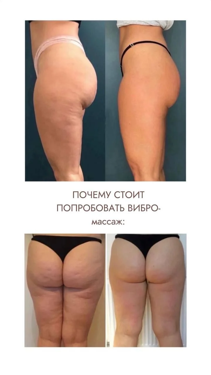 Массаж ручной антицеллюлитный аппаратный LPG вибро - миниатюра 6