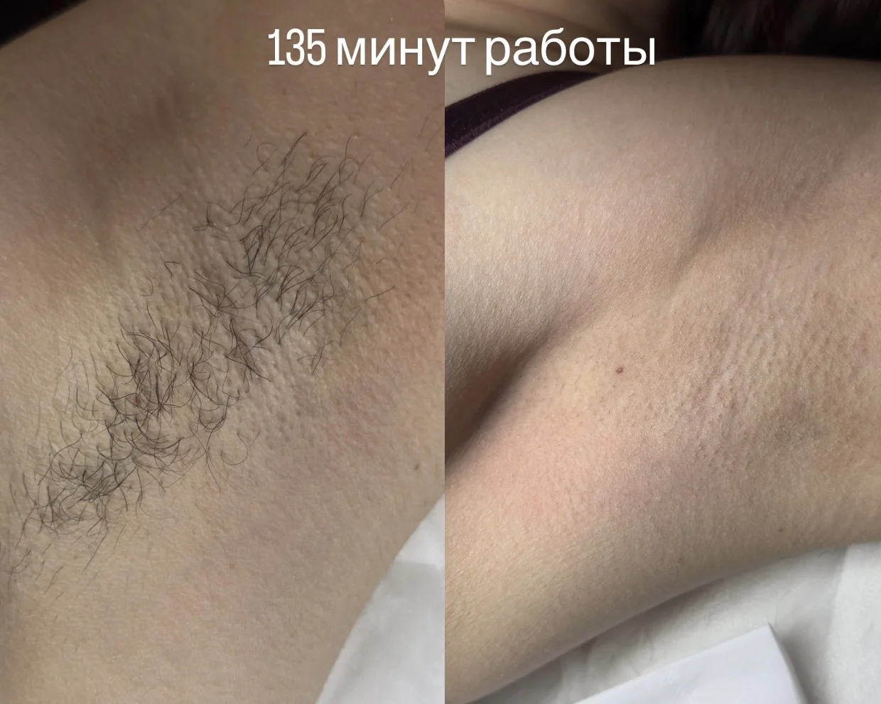 электроэпиляция - миниатюра 3