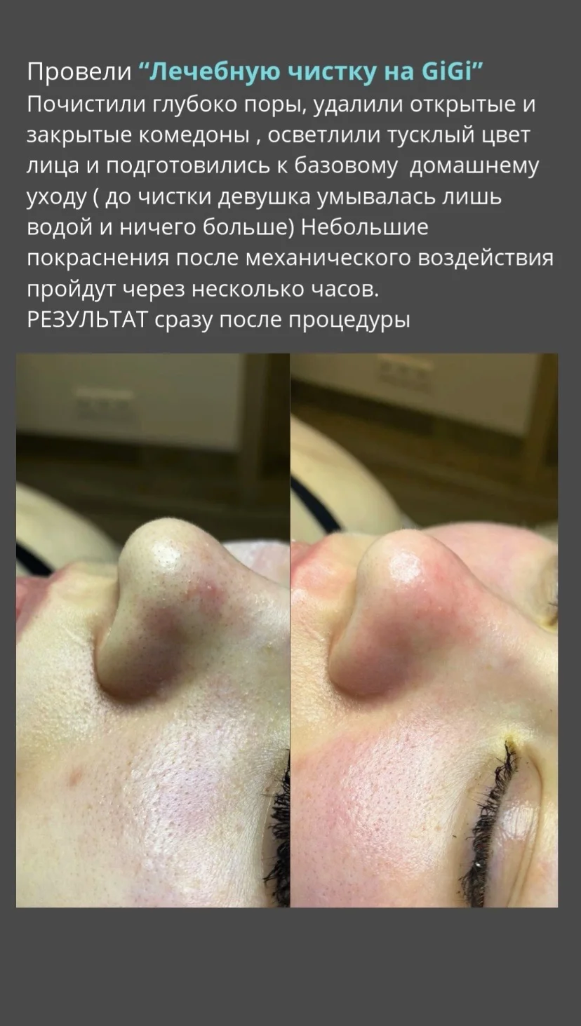 Чистка лица/ лечение Акне - миниатюра 3