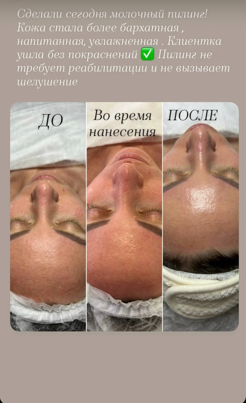 Чистка лица/ лечение Акне - миниатюра 4
