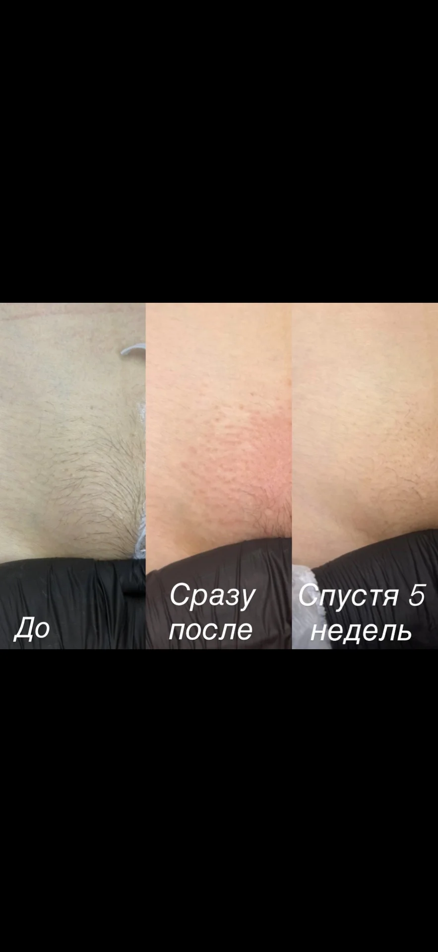 Электроэпиляция Войковская Балтийская - миниатюра 6