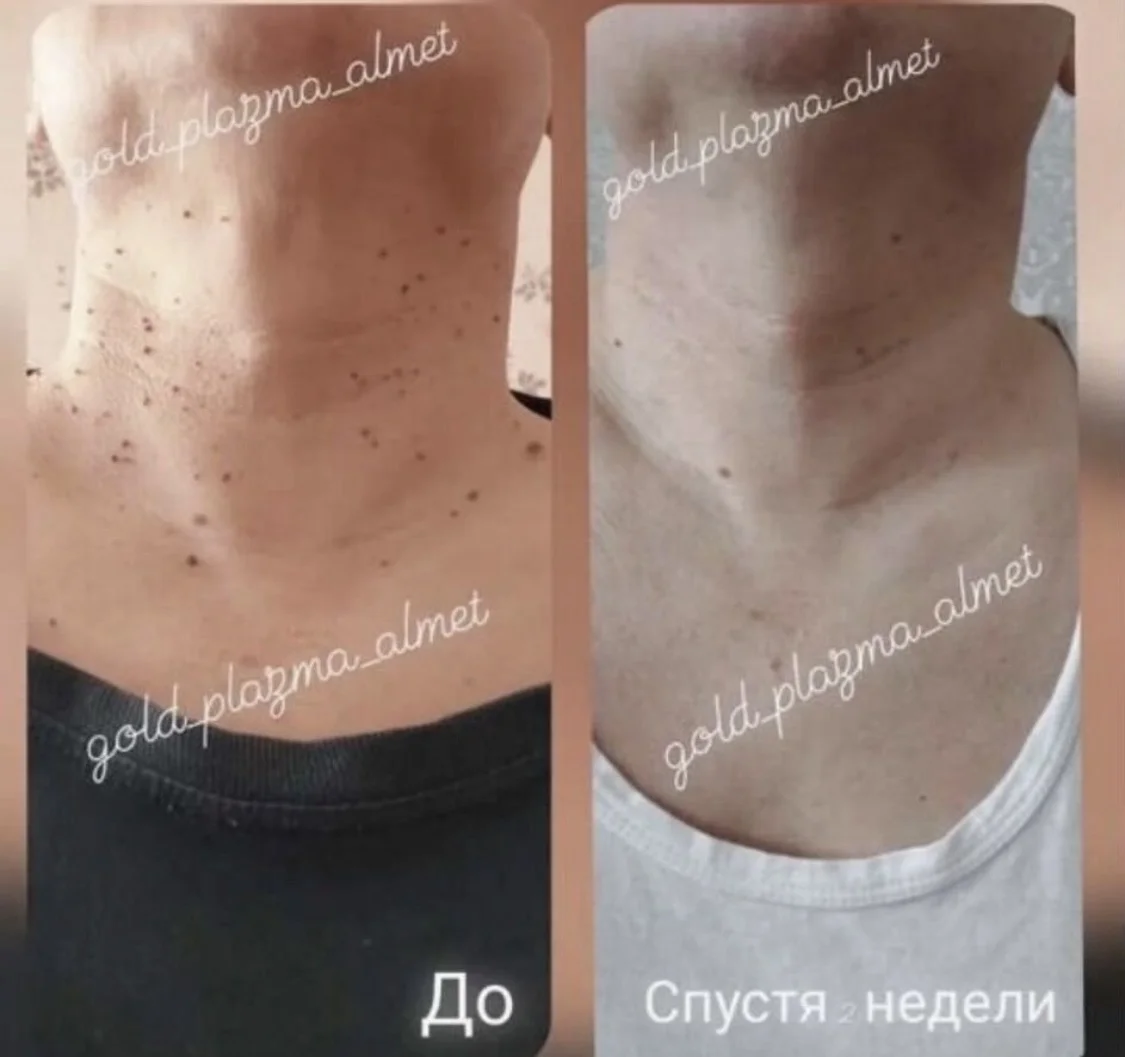 Чистка лица, удаление папилом, холодная плазма - миниатюра 8