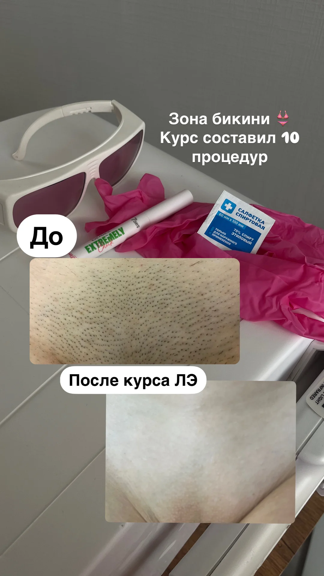 Лазерная эпиляция удаление волос - миниатюра 2