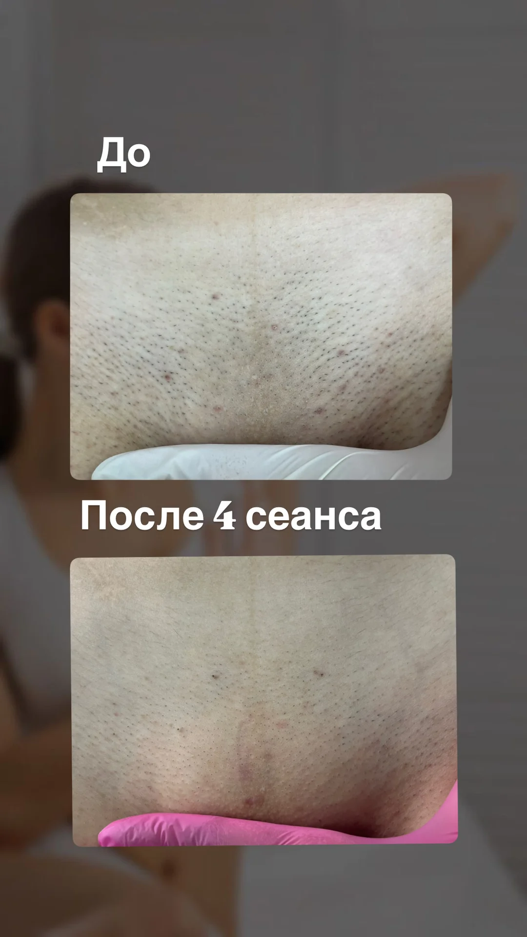 Лазерная эпиляция удаление волос - миниатюра 3