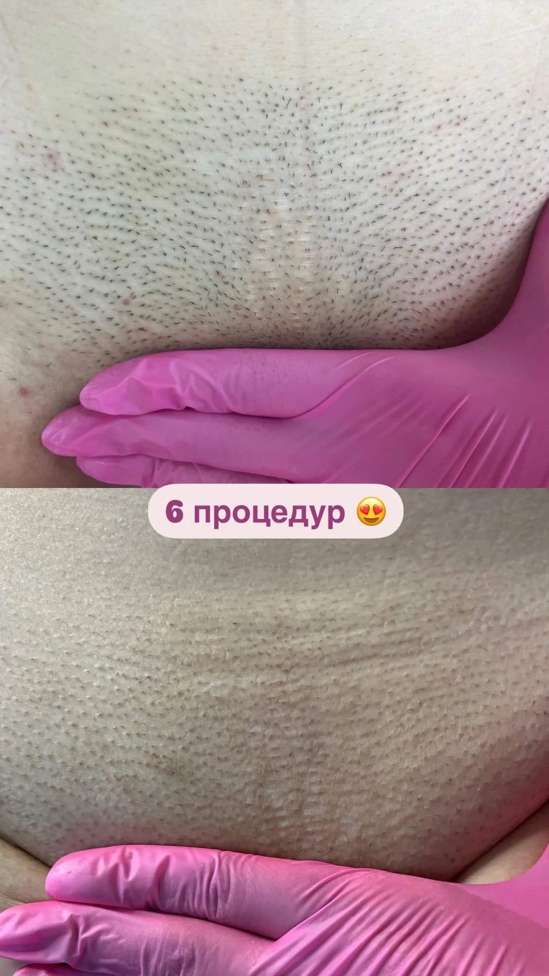 Лазерная эпиляция удаление волос - изображение 1