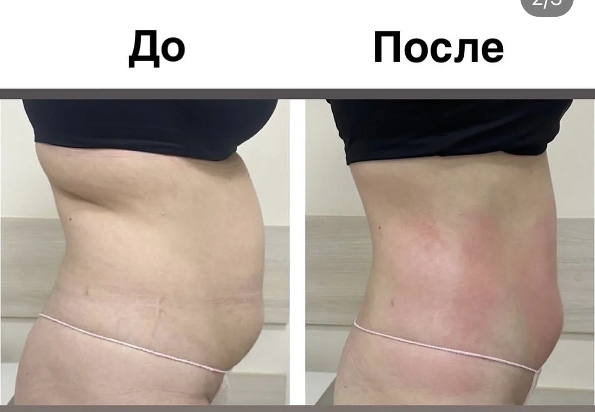 Аппаратная корреция фигуры - миниатюра 3
