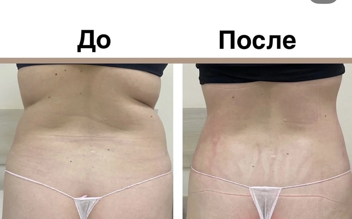 Аппаратная корреция фигуры - миниатюра 4