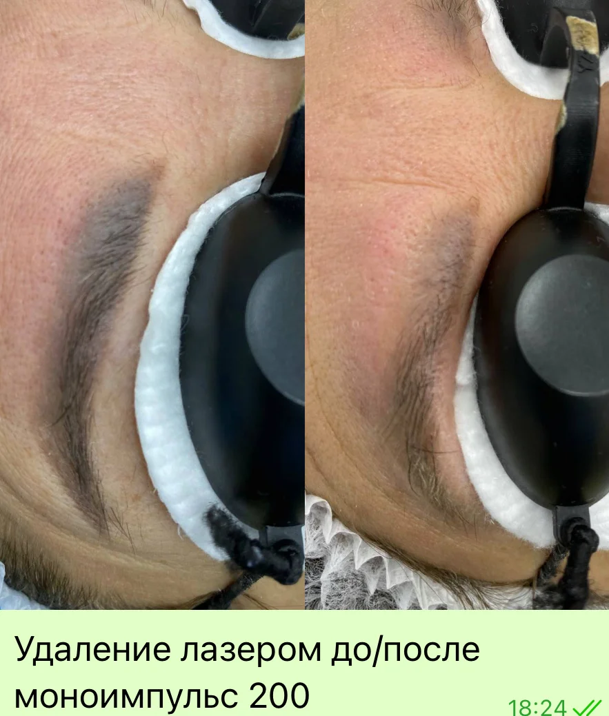 Удаление тату и перманента - миниатюра 6