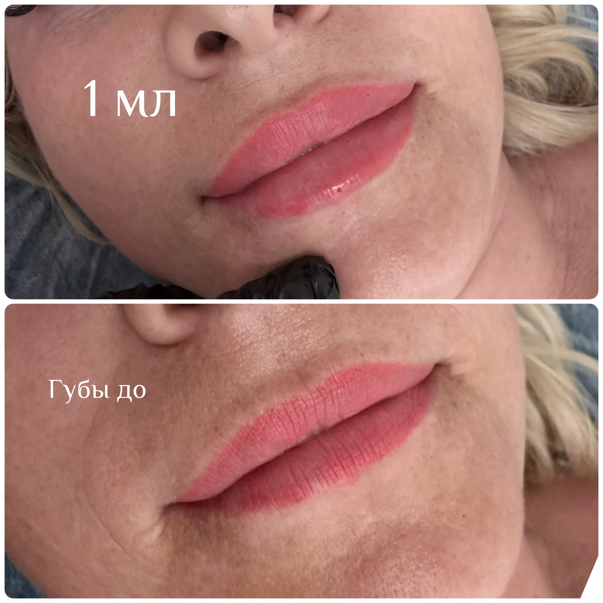 увеличение и удаление губ - миниатюра 3