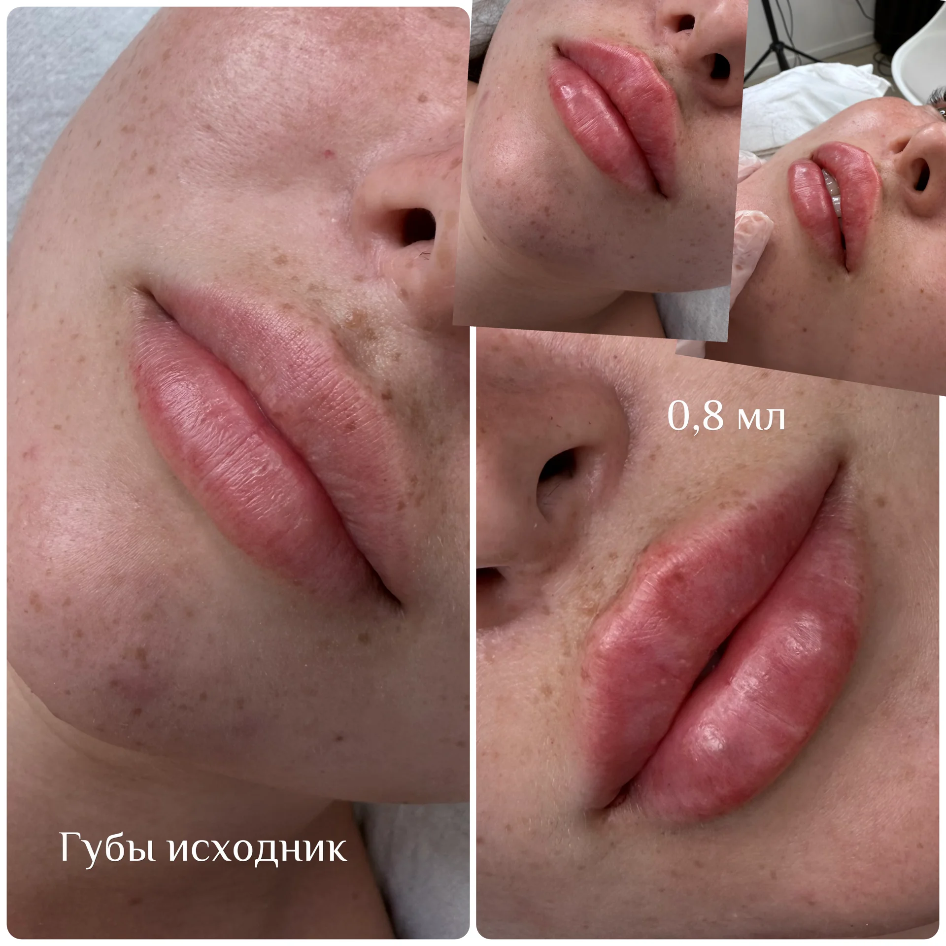 увеличение и удаление губ - миниатюра 4