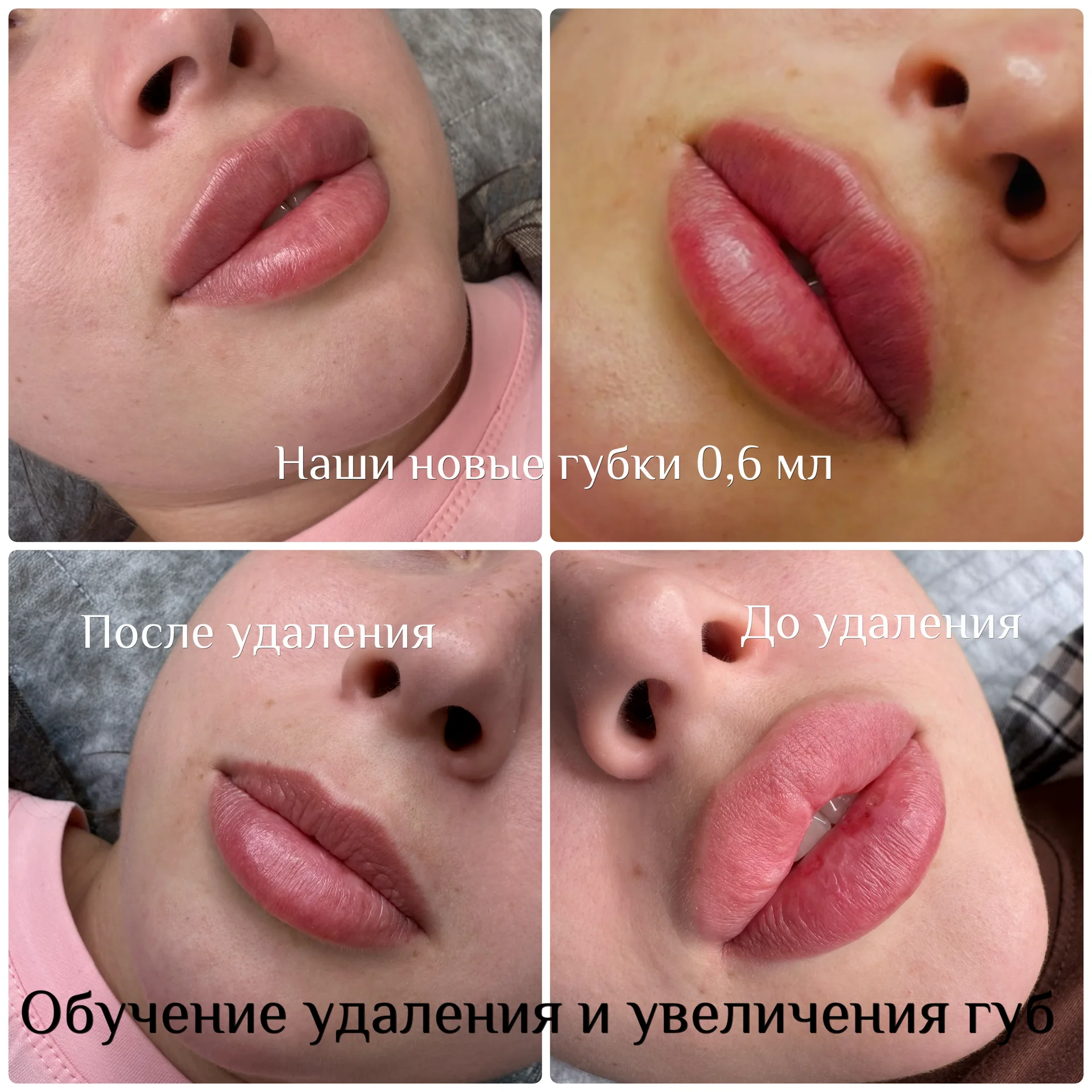 увеличение и удаление губ - миниатюра 5