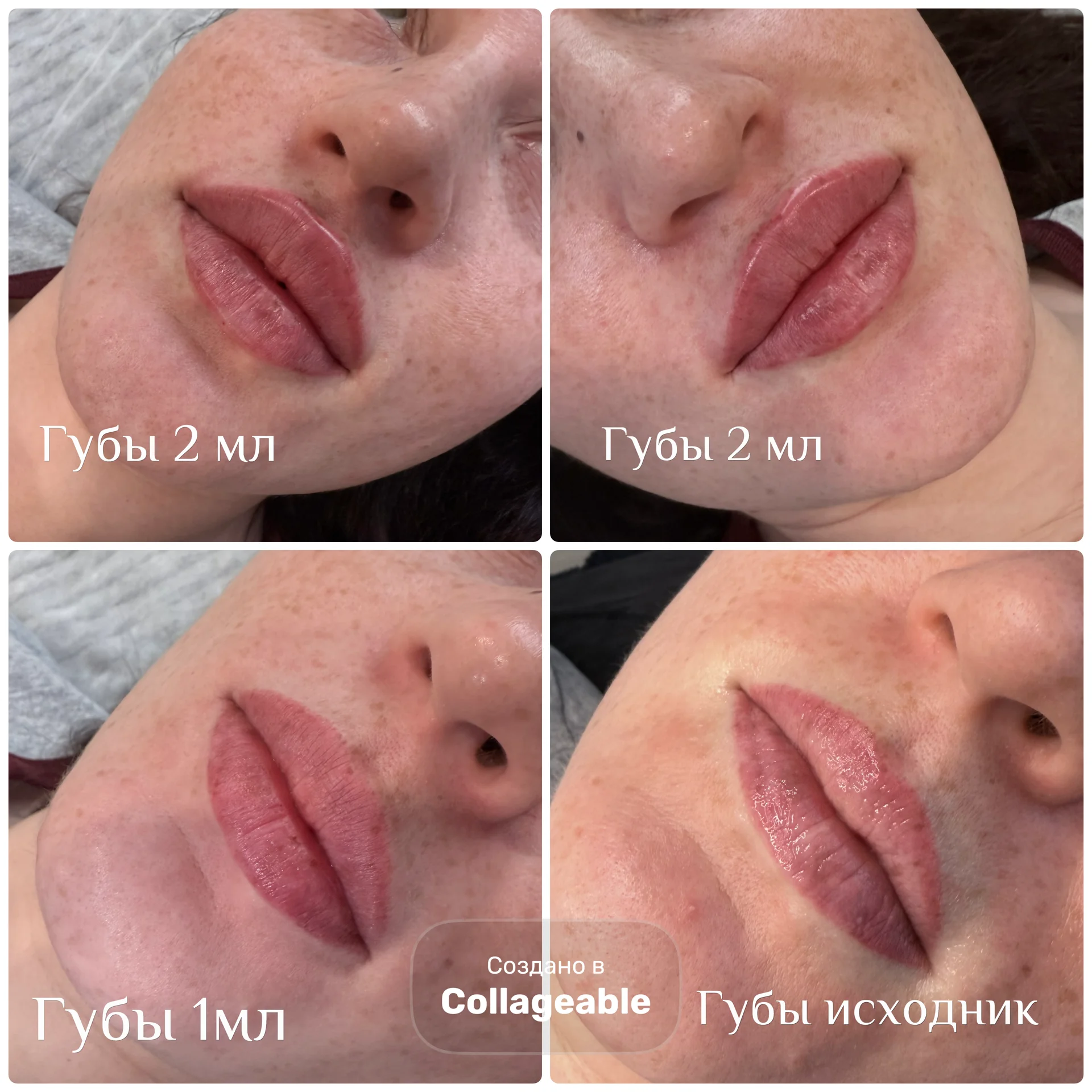 увеличение и удаление губ - миниатюра 7