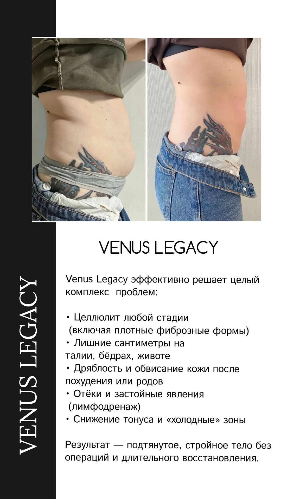 Коррекция фигуры на аппарате VENUS LEGACY - миниатюра 2