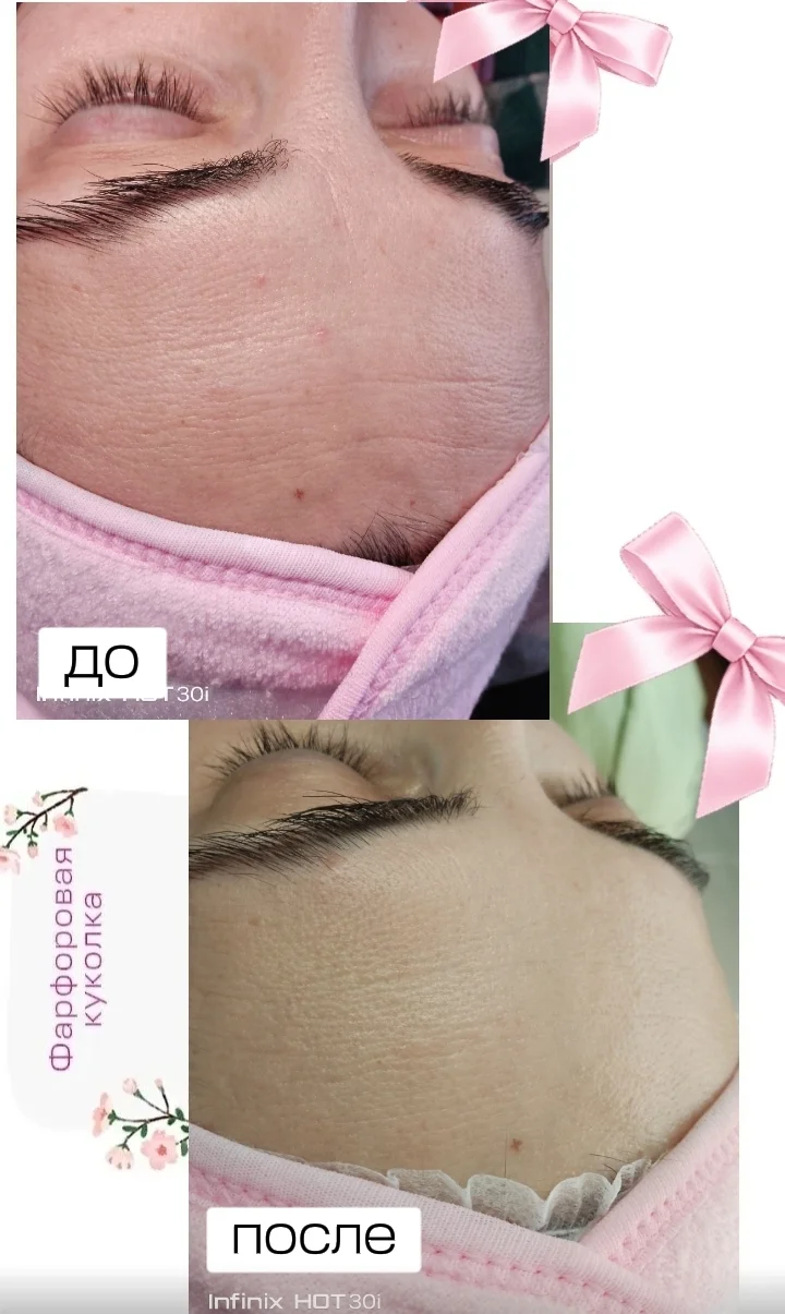 КOCMETОЛOГ | ЧИСТКА ЛИЦA | ПИЛИНГИ | УXОД - миниатюра 7