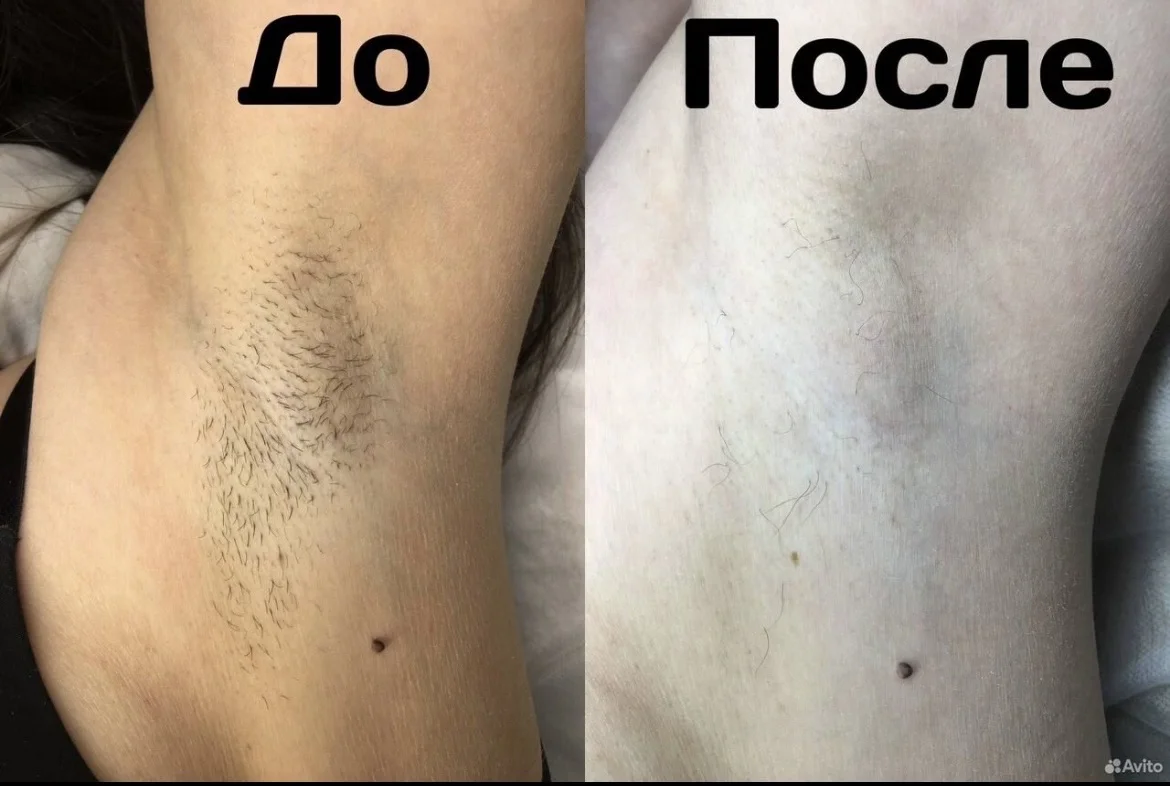 электроэпиляция удаление волос - миниатюра 3