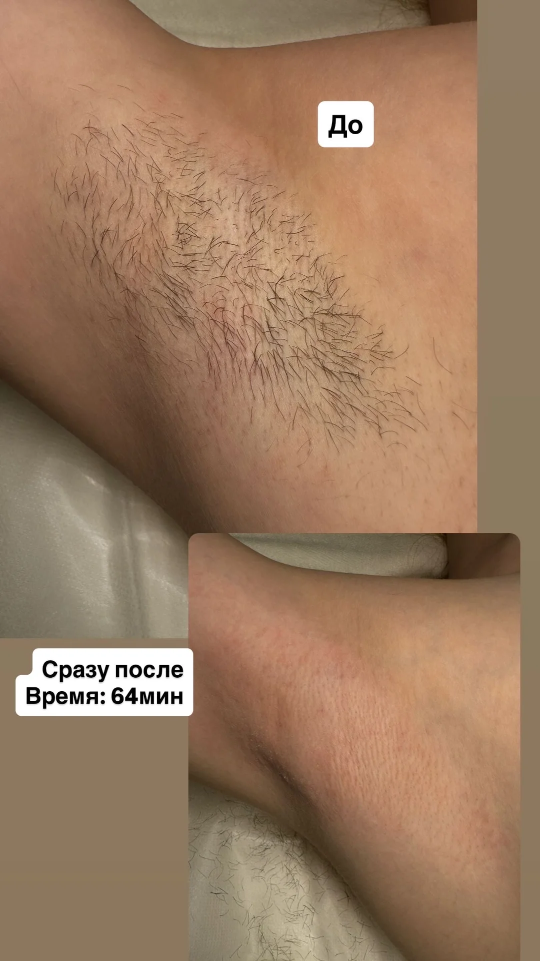 ЭЛЕКТРОЭПИЛЯЦИЯ МОСКВА|м. молодежная - миниатюра 2