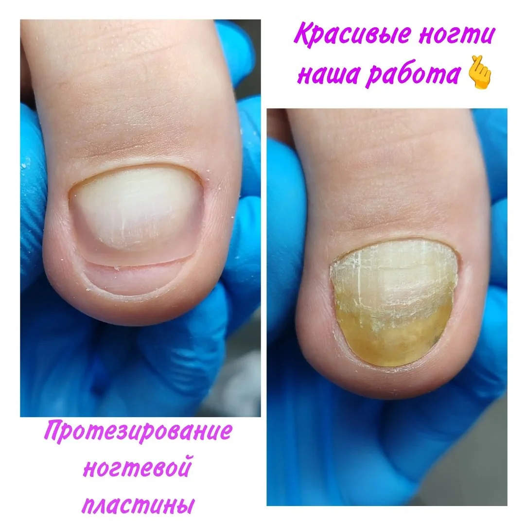 НОГТЕВАЯ ПОМОЩЬ г.Астрахань, Подолог, Педикюр и маникюр - миниатюра 5