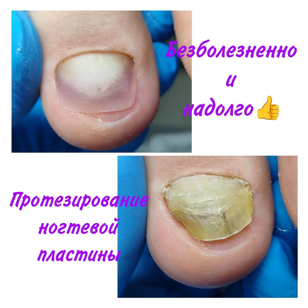 НОГТЕВАЯ ПОМОЩЬ г.Астрахань, Подолог, Педикюр и маникюр - миниатюра 6