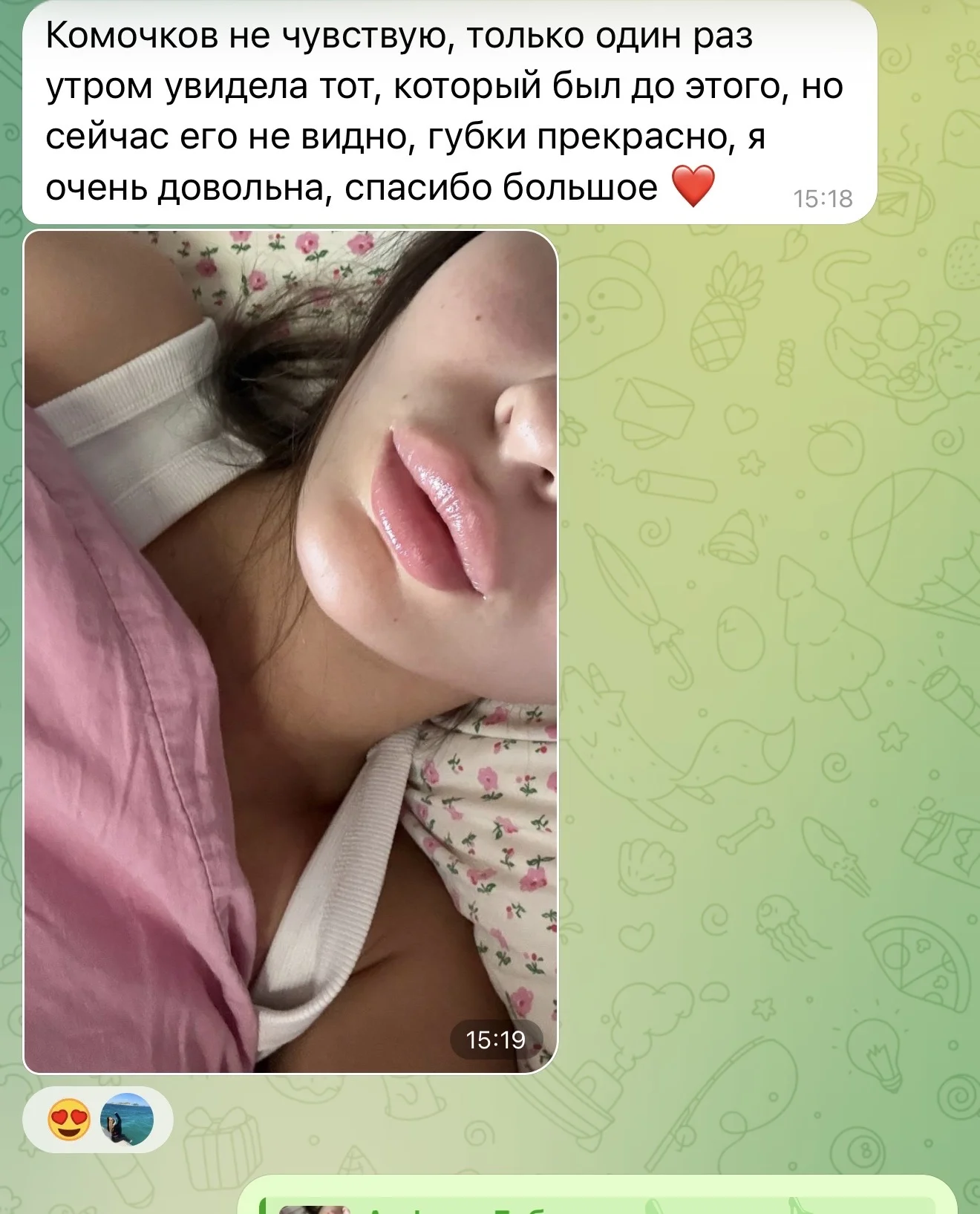 увеличение губ москва. контурная пластика губ. - миниатюра 6