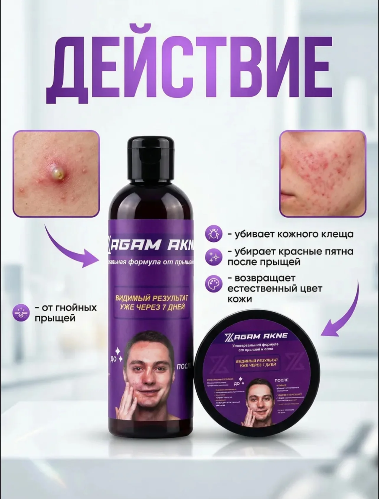Средство от прыщей и акне - миниатюра 3
