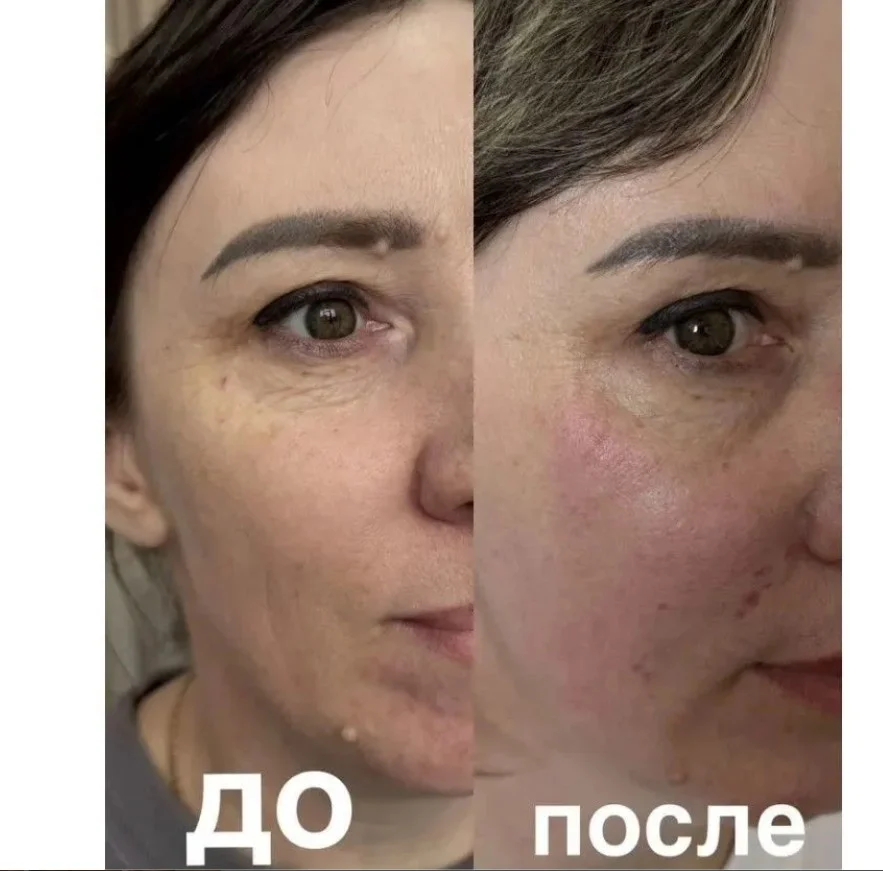 Биоревитализация лица, рук и шеи - миниатюра 7