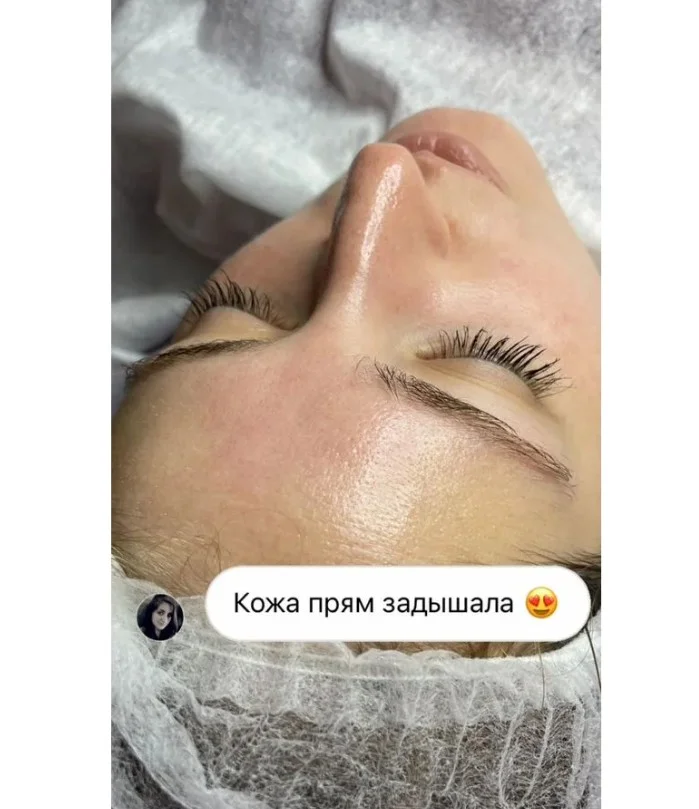 Карбокситерапия - насыщение кожи кислородом - миниатюра 2