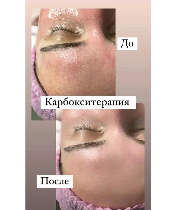 Карбокситерапия - насыщение кожи кислородом - миниатюра 3