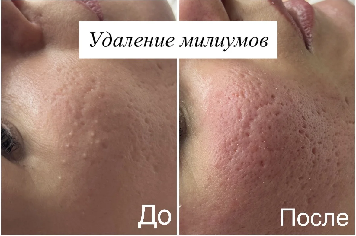 Косметолог Мезотерапия липолитики биоревитализация - миниатюра 9