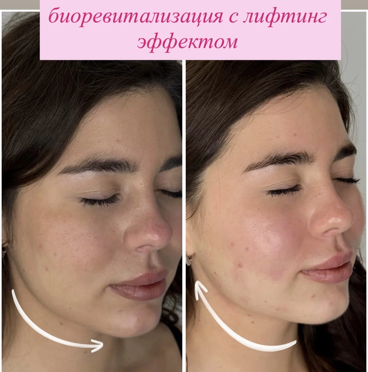 Косметолог Мезотерапия липолитики биоревитализация - миниатюра 12
