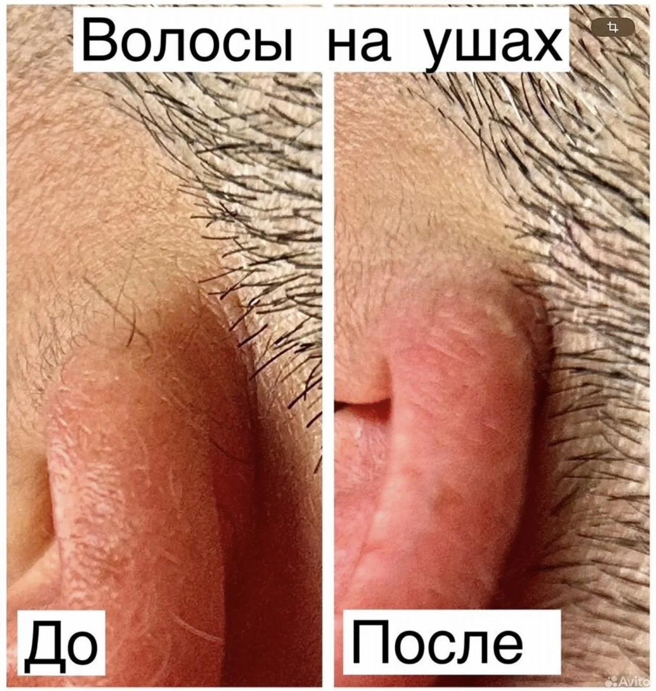 электроэпиляция - миниатюра 4