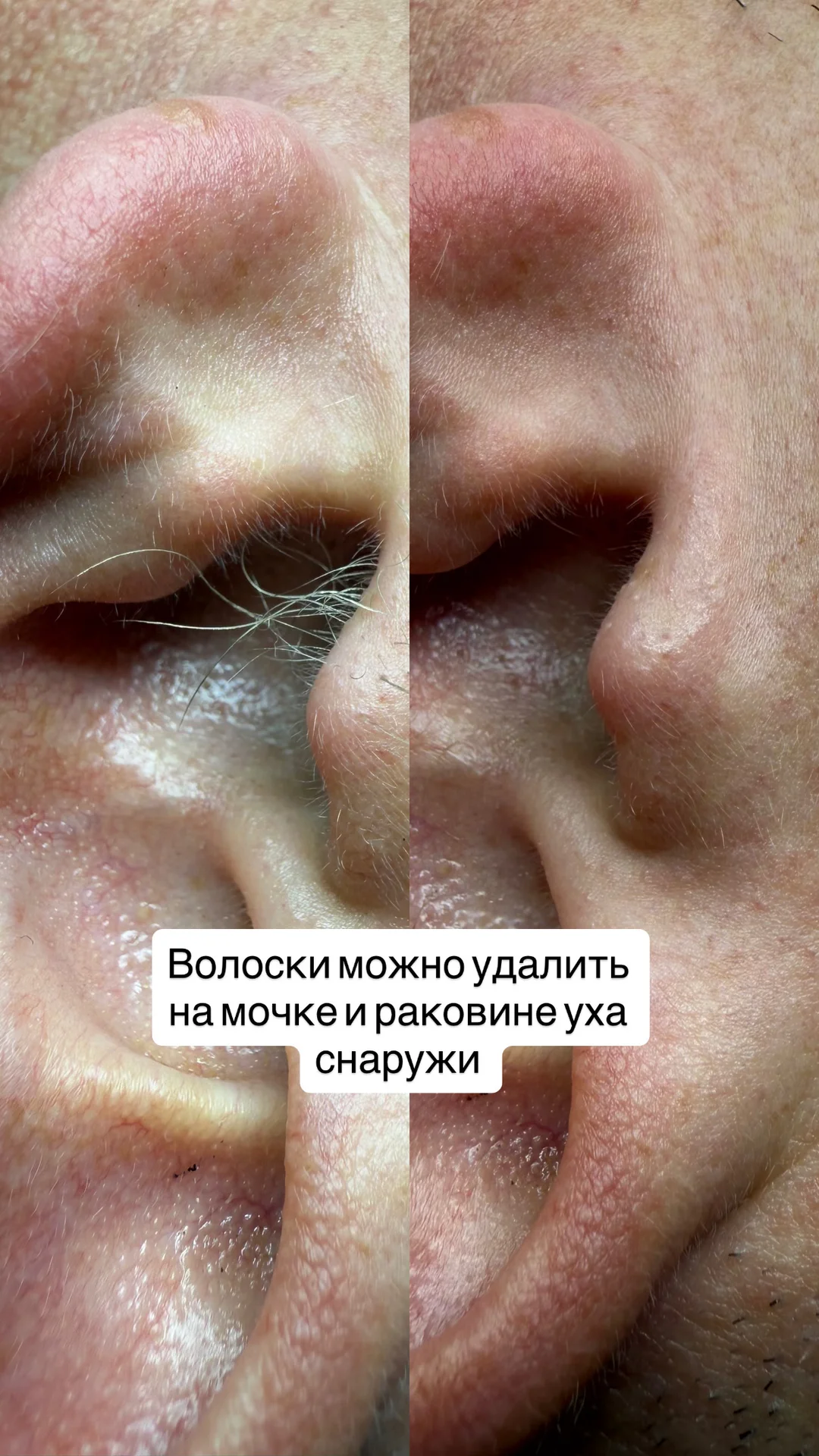 Электроэпиляция - миниатюра 5